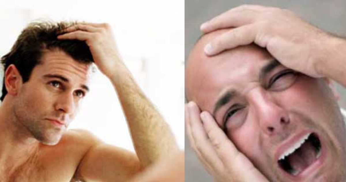 I giovani? Sempre pi� calvi: �Colpa di stress, smog e cattiva alimentazione�