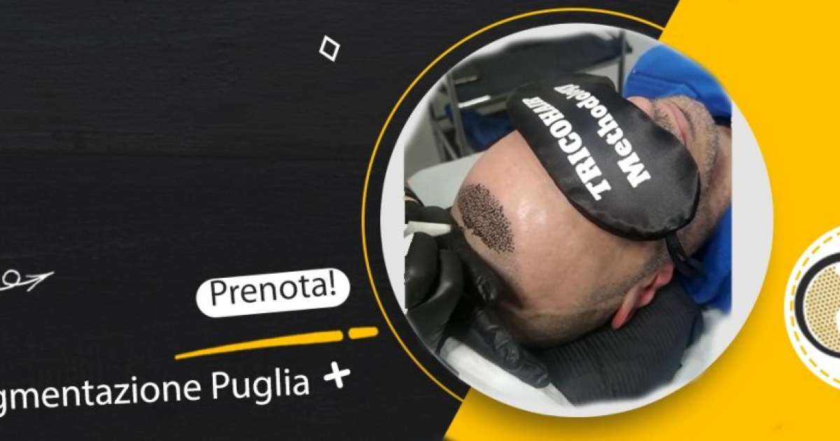 Bari svetta nei trattamenti di  tricopigmentazione