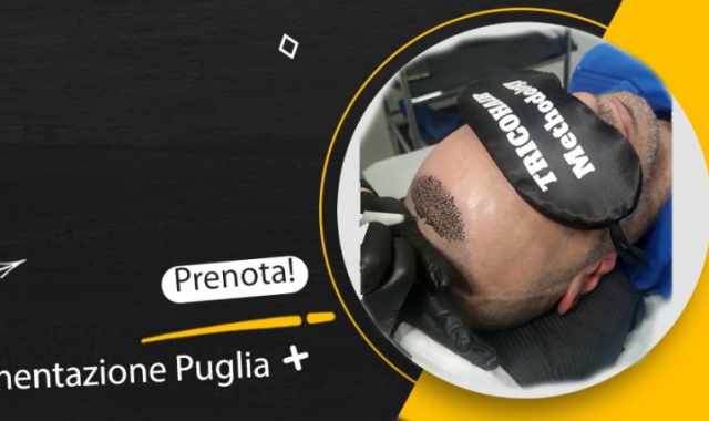 Bari svetta nei trattamenti di  tricopigmentazione