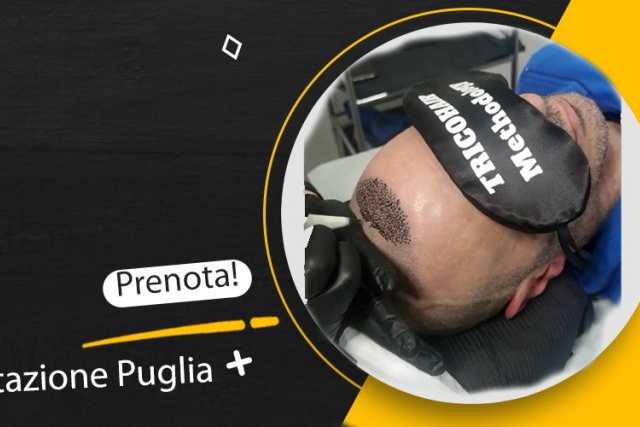 Bari svetta nei trattamenti di  tricopigmentazione